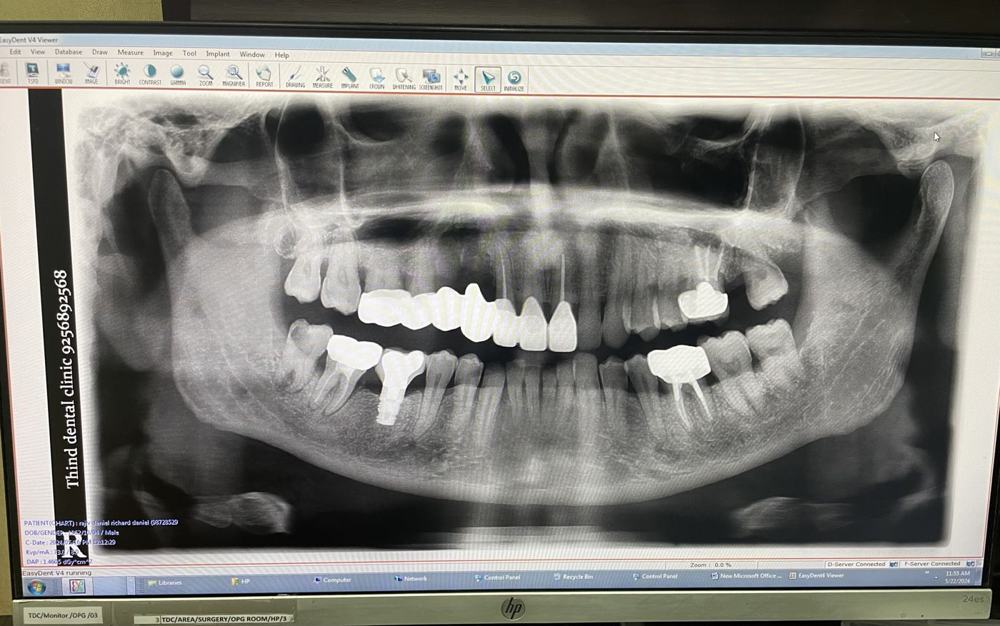 A full-mouth X-ray (OPG) on the clinic screen, used to plan implants
